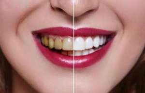 冷光美白牙齿的适应症与禁忌症详解